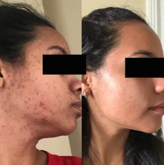 Turmeric Kojic Cleansing Pads (40 Pads)